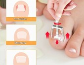 Joycabin zestaw 104 elementów do korekcji wrastających paznokci – zdjęcie 3